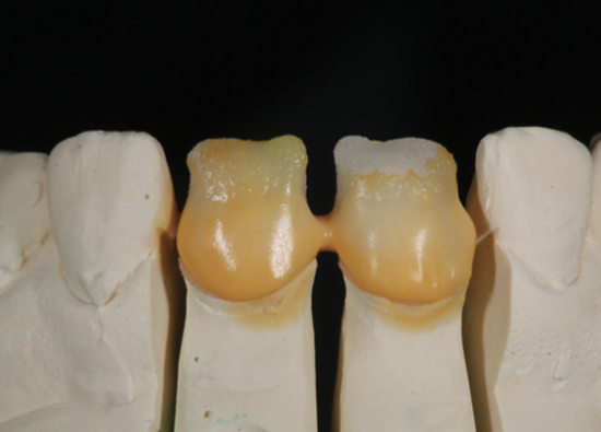 How can you manage ceramic materials for esthetic outcomes?