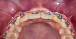 Soft- and hard-tissue deficits were present at the maxillary lateral incisor sites.