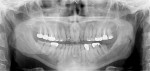 Fig 7. Panoramic radiograph taken in 2017. Note increased occlusal erosion of tooth No. 18.