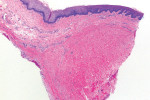 The H&E-stained biopsy from the grafted site showing the implanted hydrated ADM to be well incorporated beneath the native tissue.
