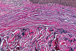 Close-up of the Verhoeff’s-stained biopsy from the grafted site showing the distinct border between the native tissue without elastin fibers and the incorporated hydrated ADM with many darkly stained elastin fibers.