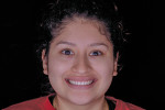 Fig 1. Pretreatment full-face photograph. The patient did not like the size, shape, or color of her teeth and was dissatisfied with the amount of gingival display.