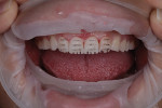 Fig 11. Teeth were prepared through the provisionals.