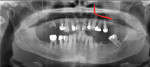 (1.) Preoperative panoramic radiograph demonstrating generalized severe periodontal disease associated with dental decay and missing teeth, confirming the poor prognosis of the patient’s dentition. The red line shows an L-shaped anterior extension of the left sinus cavity, which is favorable for a trans-sinus dental implant.