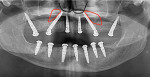(10.) Postoperative panoramic radiograph acquired to verify proper implant placement, abutment seating, and bone graft placement. The black line indicates the nasal rim and pyriform aperture where the apexes of the trans-sinus implants were anchored. The red outlines indicate the bone grafted areas.