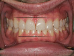 Fig 7. Post-treatment porcelain veneers Nos. 7 through 10. Note the maxillary and mandibular facial levels in relation to the canines (as indicated by the black horizontal lines).