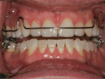 Fig 8. Kois deprogrammer and mandibular orthodontic brackets in place, at 3-year follow-up.
