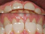 Fig 9. Post-orthodontic treatment (6 o’clock view, top; inverted frontal view, bottom). Note the patient’s anterior clearance of 1 mm to 2 mm.