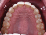 Fig 10. Maxillary occlusal view 14 years post-treatment. Note intact porcelain veneers Nos. 7 through 10.