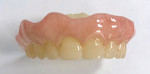 Fig 5. From the initial scans, a monolithic (polymethyl methacrylate [PMMA]) (Carbon®, shade A1) printed healing denture with gingival characterization and glazing was requested from the lab.