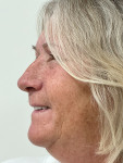 Fig 13. Profile view of the patient with final denture demonstrating detail of the excellent esthetics and lip line.