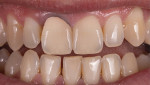 Fig 5. Darkening and inflammation of the gingival tissue were still evident.