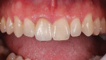 Fig 13. Intraoral view, 10 days after cementation.