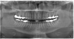 Fig 1. Preoperative panoramic radiograph showing apical radiolucency, tooth No. 18.