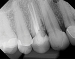 (1.) Pretreatment periapical radiograph of the maxillary first premolar showing prior endodontic treatment and a large apical abscess.