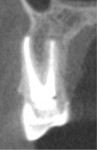 (2.) CBCT cross-sectional view demonstrating dehiscence of the buccal root.