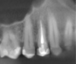 (3.) Virtual implant planning software image showing a periapical view of the tooth.