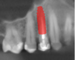 (4.) Virtual implant planning software image showing a periapical view with the virtual implant placed.