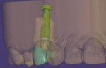 (15. THROUGH 17.) Buccal view of the virtual design of the custom abutment on the virtual implant and buccal and occlusal views of the virtual design of the screw-retained provisional crown.