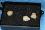(18.) The restorative components fabricated and returned with the surgical guide included a custom healing abutment, custom final zirconia abutment, and a provisional crown.