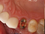 (19.) Occlusal view of the tooth following removal of the coronal restoration.