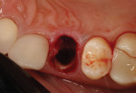 (20.) Occlusal view of the extraction socket and the remaining portion of the buccal root following PET.