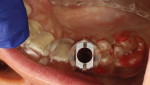 (21.) Occlusal view of the surgical guide seated on the teeth in preparation for implant site preparation.