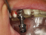 (23.) Buccal view of the implant being placed through the surgical guide.