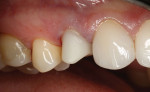 (27. AND 28.) Placement of the custom zirconia abutment.