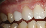 (29.) Close-up buccal view of the provisional crown, which was luted to the custom abutment with temporary cement to yield a screw-retained provisional restoration.