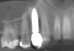 (30. AND 31.) Buccal radiographic comparison of the planned implant position and the placed implant with its immediate restoration, respectively, demonstrating the accuracy achieved with the surgical guide.