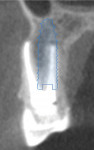 (32. AND 33.) Cross-sectional radiographic comparison of the planned implant position and the placed implant with its immediate restoration, respectively, demonstrating that placement via the surgical guide matched the planned position.