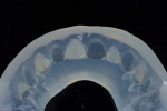 (10.) A more transparent shade of composite (IPS Empress Direct [Trans 30], Ivoclar) was placed into the incisal part of the first matrix, followed by an enamel shade (IPS Empress Direct [B1 Enamel], Ivoclar) in the middle and cervical third. The matrix was then placed onto the teeth, and the final composite layers were light cured through it.