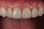 (16.) Postoperative close-up maxillary view showing the internal characterization of the veneers achieved using this technique.