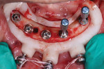 (15.) Multi-unit abutments were placed on the implants.