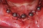 (16.) After healing caps were placed on the multi-unit abutments, the soft tissue was sutured around them.
