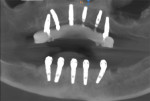 (25.) Posttreatment panoramic radiograph demonstrating the position and angulation of the new implants.
