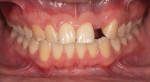 (1.) Preoperative retracted photograph of a patient with partial edentulism at the site of tooth No. 10.
