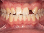 (2.) The patient’s occlusal scheme was evaluated to ensure that he had a sufficient overbite and would not guide off of the tooth No. 10 pontic once placed.