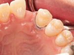 (4.) The lingual and mesial surfaces of tooth No. 11 were prepared to a depth of approximately 0.5 mm.