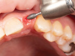 (6.) A gingivoplasty was completed at the edentulous tooth No. 10 site to create a natural-looking gingival emergence profile for the pontic.