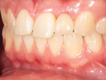 (8.) Close-up retracted left lateral view of the zirconia resin-bonded fixed partial denture acquired 2 weeks postoperatively.