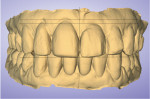 Fig 2. Preoperative scan of the patient. Note the second vertical line from the top, in line with tooth No. 10, and the first vertical line, in line with No. 9. Teeth Nos. 7 and 8 will have gingival contouring done to correct this asymmetry. Tooth No. 10 is in labial version and too long. Also, the smile line needs to drop down starting from mid to distal of tooth No. 8 so it is symmetrical bilaterally to the bottom horizontal plane line.