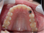 Fig 12. Occlusal view at 3 months healing after implant uncovery and placement of healing abutment.