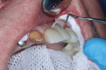 (5.) Cleanup was initiated by using an instrument to break the excess cement from the margins, gently pushing it in the direction of the gingiva.