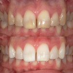 (3.) A series of before-and-after photographs showing the results of Kör Whitening treatment.
