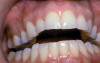 (Figure 4.) Gingival recession with exposed root surfaces are susceptible to dentinal hypersensitivity facial surfaces of maxillary teeth with recession with symptoms of dentin hypersensitivity.