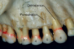 Figure 16  Dehiscence (tooth No. 5) and fenestration (teeth Nos. 3 and 6).