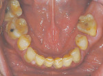Figure 5  Occlusal view of mandibular jaw at presentation.