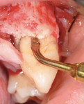 Figure 6  Piezosurgery tip EX 1 in use mesial to tooth No. 11 to create a 